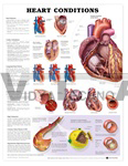 Heart Conditions Anatomical Chart